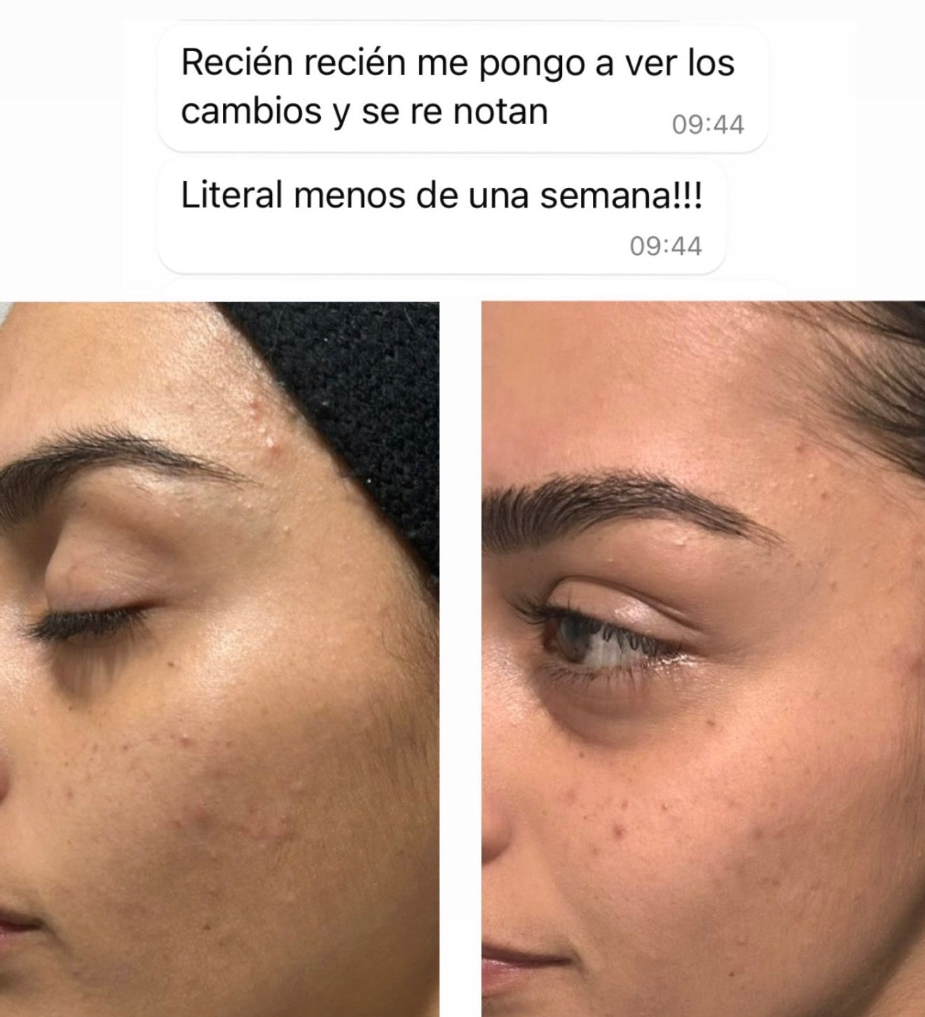 CLEARADVANCE™ - Combate el acné hormonal