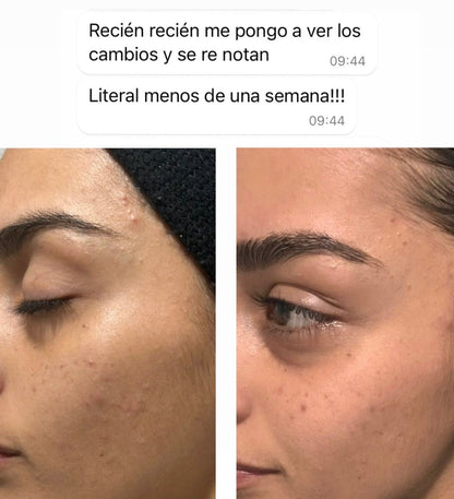 CLEARADVANCE™ - Combate el acné hormonal