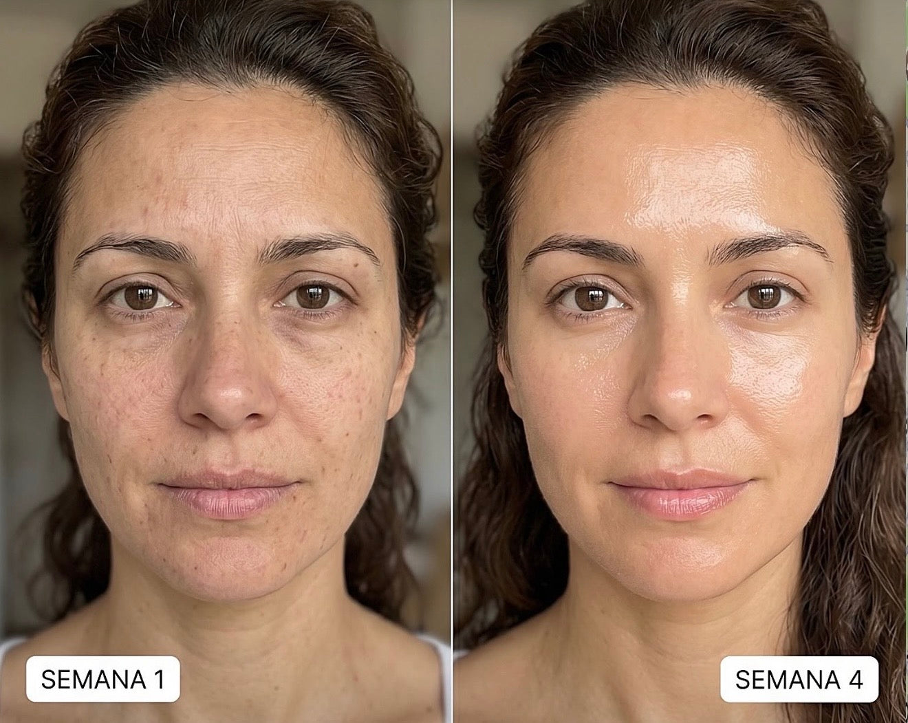 CLEARADVANCE™ - Combate el acné hormonal