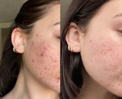 CLEARADVANCE™ - Combate el acné hormonal